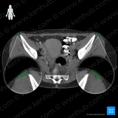 Musculus tensor fasciae latae (Schenkelbindenspanner); Bild: 