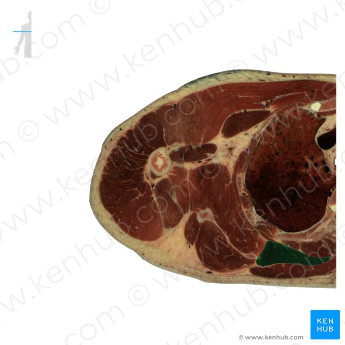 Músculo romboide maior (Musculus rhomboideus major); Imagem: National Library of Medicine