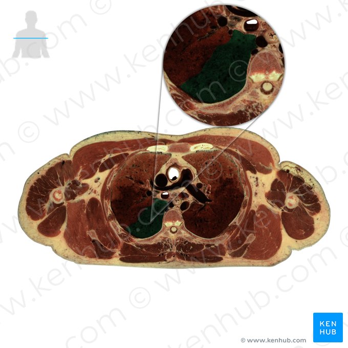 Lobo inferior do pulmão direito (Lobus inferior pulmonis dextri); Imagem: National Library of Medicine