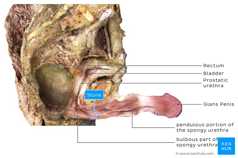 Urethral Stone - Cadaveric Image