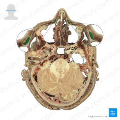 Musculus levator labii superioris alaeque nasi (Oberlippen- und Nasenflügelheber); Bild: National Library of Medicine