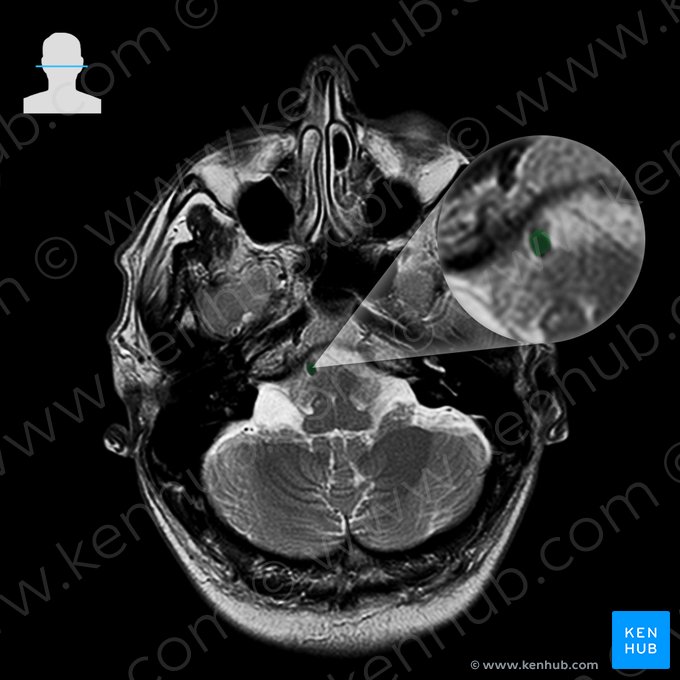 Arteria basilaris (Basilararterie); Bild: 