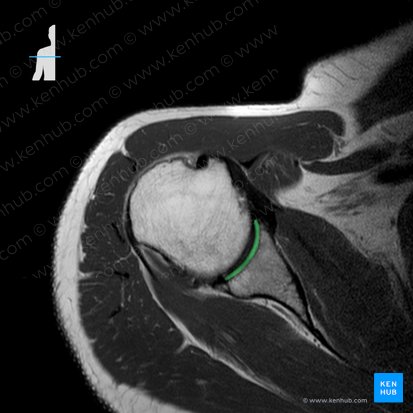 Fossa glenoidalis scapulae (Gelenkpfanne des Schulterblatts); Bild: 