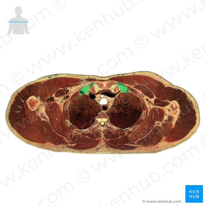Costa 1 & cartilago costalis 1 (1. Rippe und Rippenknorpel); Bild: National Library of Medicine