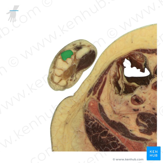 Base do 2.º metacarpal (Basis ossis metacarpi 2); Imagem: National Library of Medicine