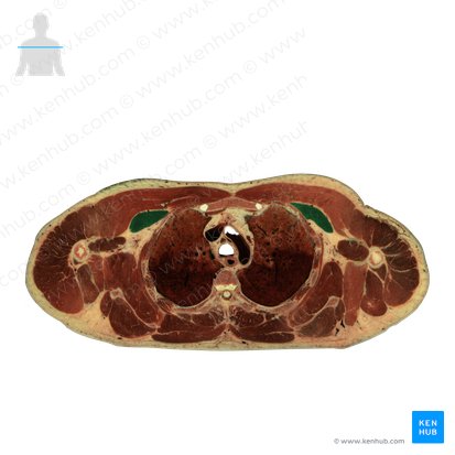 Pectoralis minor muscle (Musculus pectoralis minor); Image: National Library of Medicine