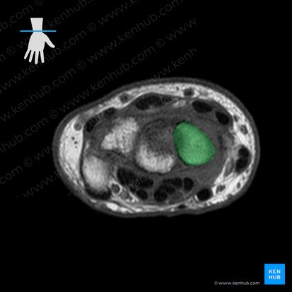 Scaphoid bone (Os scaphoideum); Image: 