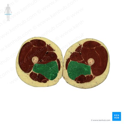 Adductor magnus muscle (Musculus adductor magnus); Image: National Library of Medicine