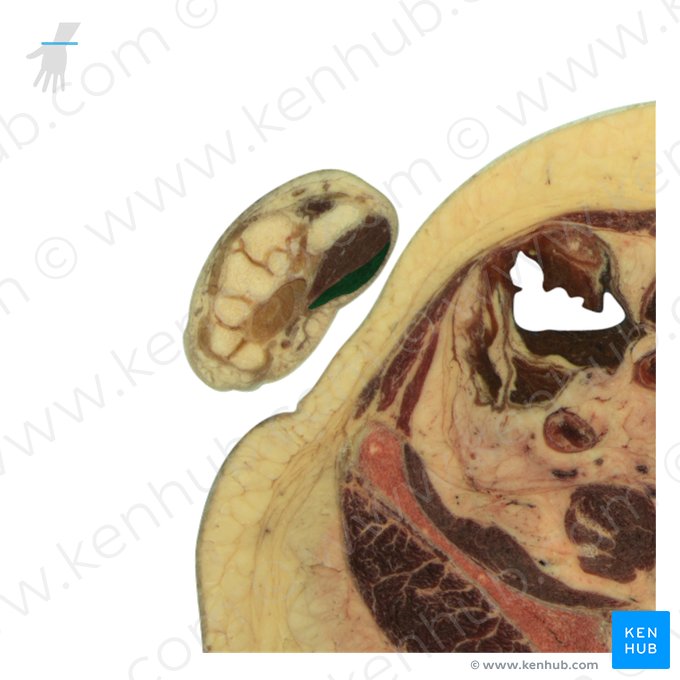 Abductor pollicis brevis muscle (Musculus abductor pollicis brevis); Image: National Library of Medicine