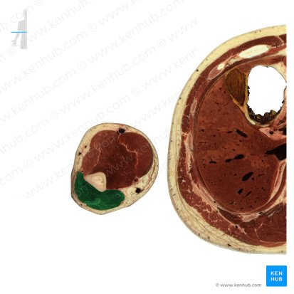 Triceps brachii muscle (Musculus triceps brachii); Image: National Library of Medicine