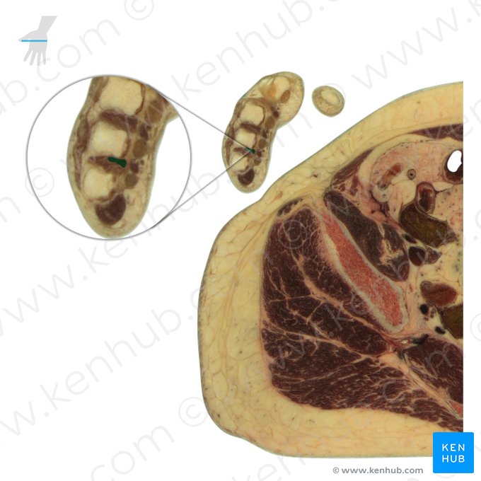 3.º músculo interósseo palmar (Musculus interosseus palmaris 3); Imagem: National Library of Medicine