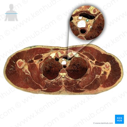 Arteria carotis communis sinistra (Linke gemeinsame Halsschlagader); Bild: National Library of Medicine