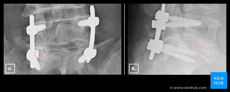 Lateral and frontal radiograph - intervertebral cage