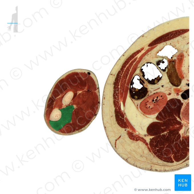 Músculo flexor profundo dos dedos (Musculus flexor digitorum profundus); Imagem: National Library of Medicine