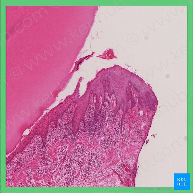 Gingiva (Zahnfleisch); Bild: 