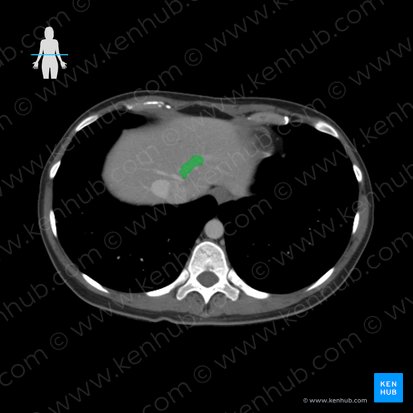 Left hepatic vein (Vena hepatica sinistra); Image: 