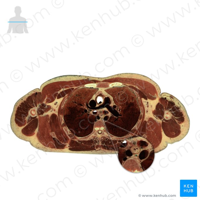 Ductus thoracicus (Milchbrustgang); Bild: National Library of Medicine