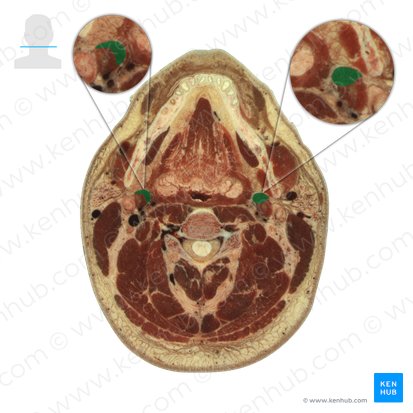 Músculo estilohioideo (Musculus stylohyoideus); Imagen: National Library of Medicine