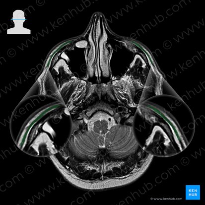 Músculo orbicular del ojo (Musculus orbicularis oculi); Imagen: 