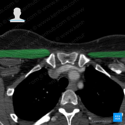 Músculo pectoral mayor (Musculus pectoralis major); Imagen: 