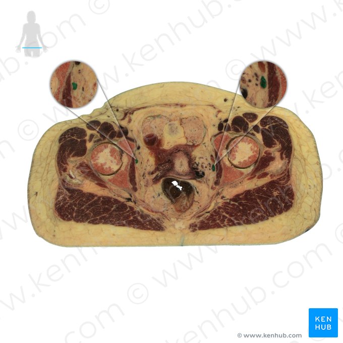 Veia ilíaca interna (Vena iliaca interna); Imagem: National Library of Medicine