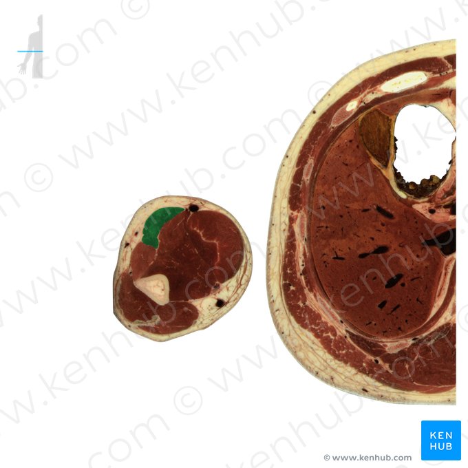 Brachioradialis muscle (Musculus brachioradialis); Image: National Library of Medicine