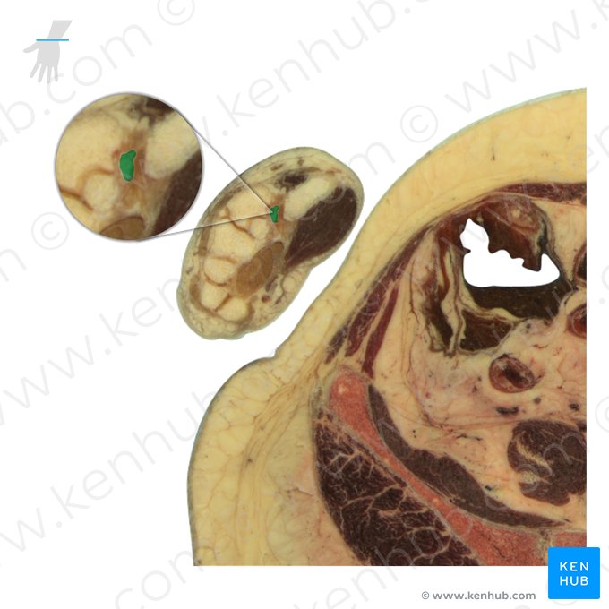 Trapezium bone (Os trapezium); Image: National Library of Medicine