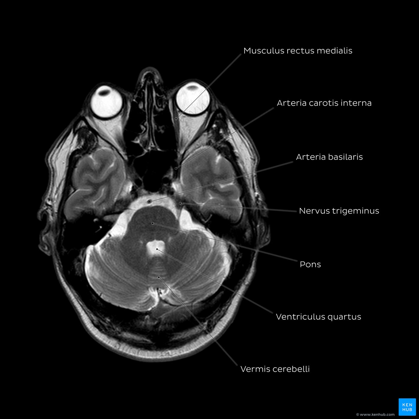 T2 MRI through the lower pons