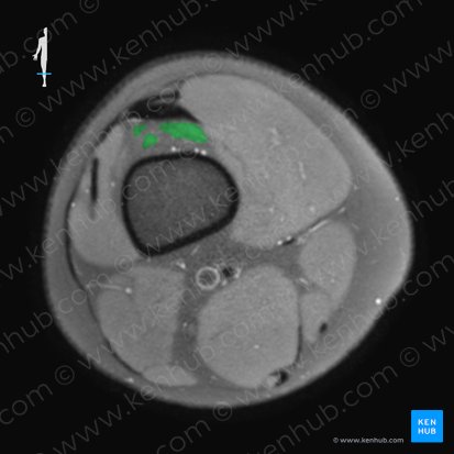 Musculus articularis genus (Muskel des Kniegelenks); Bild: 