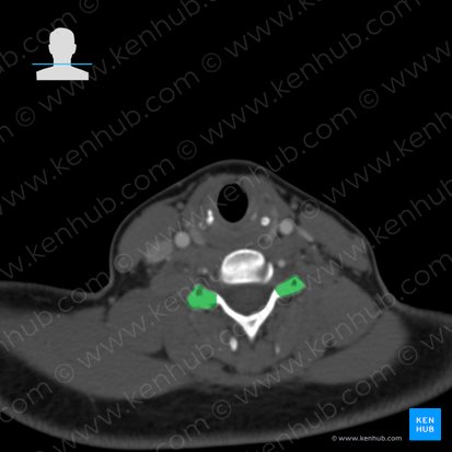 Processus articularis superior vertebrae C6 (Oberer Gelenkfortsatz des Wirbels C6); Bild: 