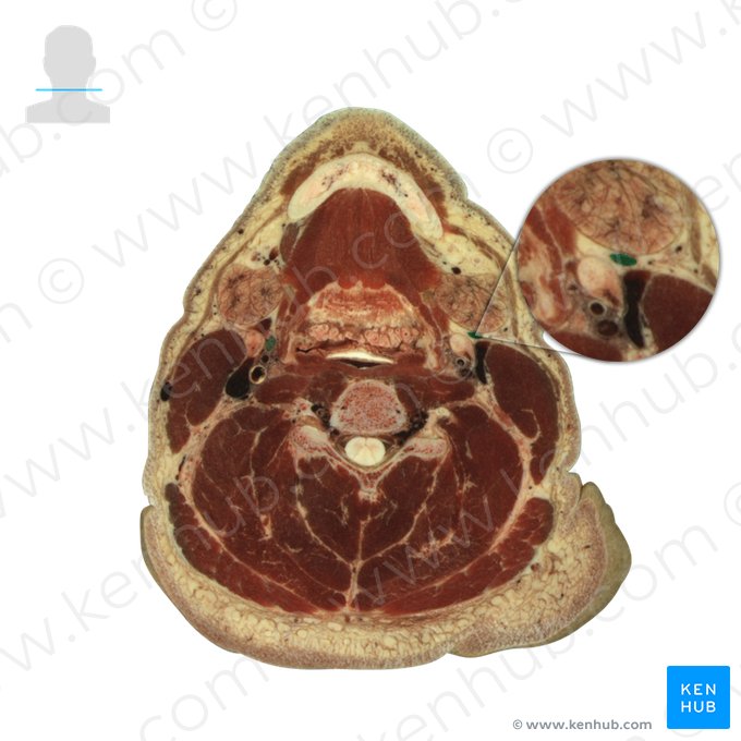 Facial vein (Vena facialis); Image: National Library of Medicine