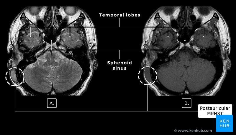 Malignant Peripheral Nerve Sheath Tumor - MRI