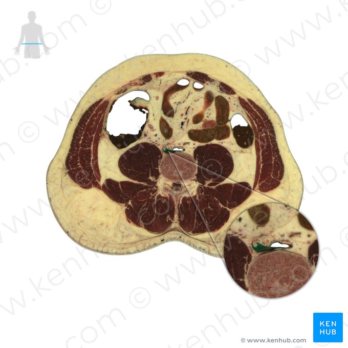 Inferior vena cava (Vena cava inferior); Image: National Library of Medicine