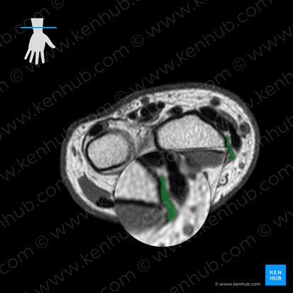 Tendon of brachioradialis muscle (Tendo musculi brachioradialis); Image: 