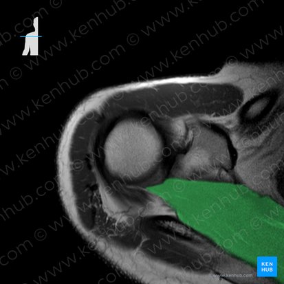 Musculus supraspinatus (Obergrätenmuskel); Bild: 