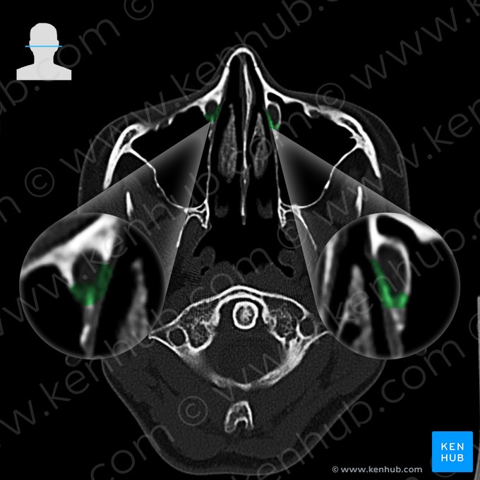 Osso lacrimal (Os lacrimale); Imagem: 