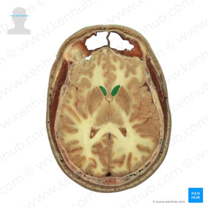 Head of caudate nucleus (Caput nuclei caudati); Image: National Library of Medicine