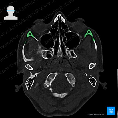Os zygomaticum (Jochbein); Bild: 
