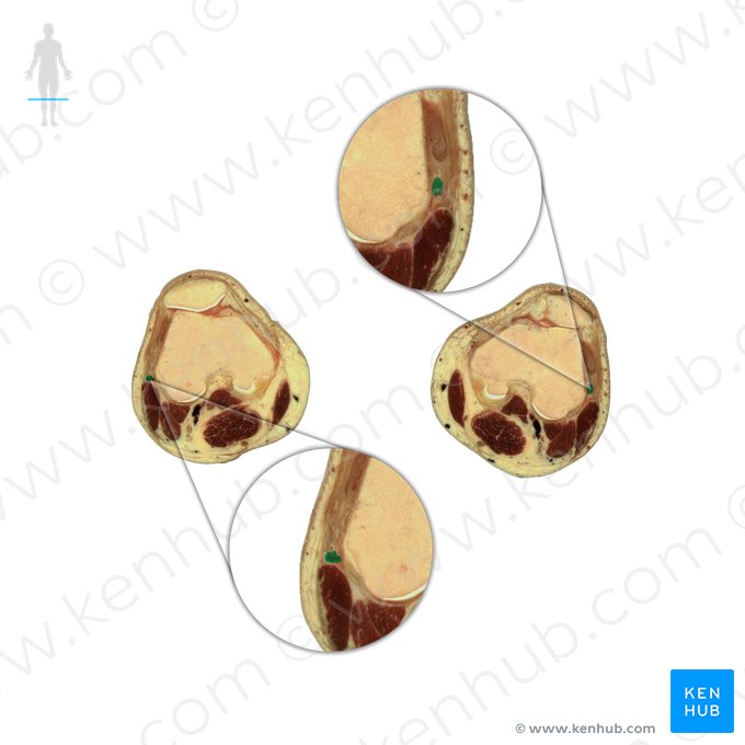 Fibular collateral ligament of knee joint (Ligamentum collaterale fibulare genus); Image: National Library of Medicine