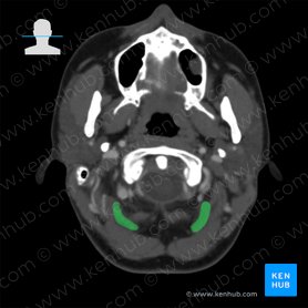 Músculo reto posterior maior da cabeça (Musculus rectus capitis posterior major); Imagem: 