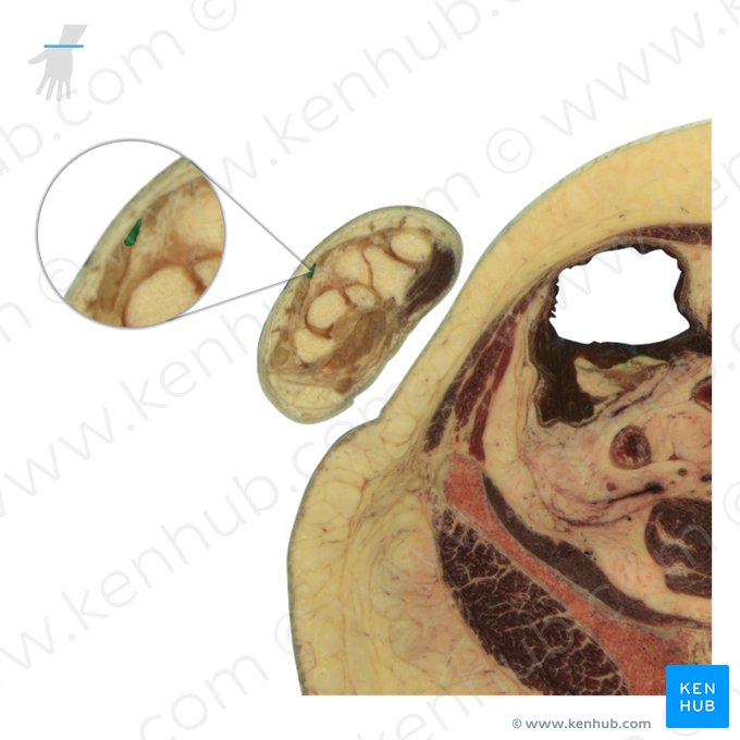 Tendo musculi extensor indicis (Sehne des Zeigefingerstreckers); Bild: National Library of Medicine