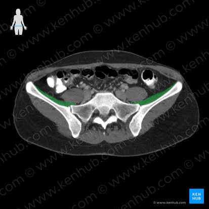 Iliacus muscle (Musculus iliacus); Image: 