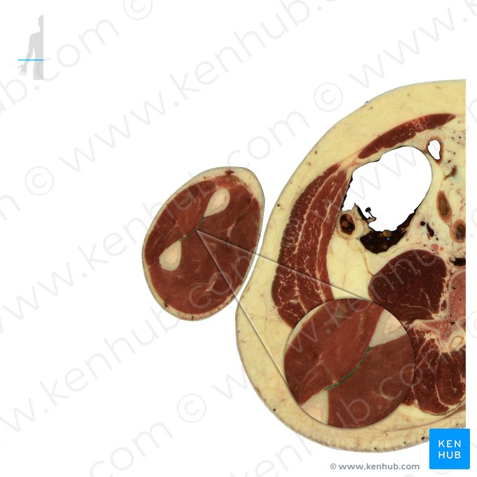 Interosseous membrane of forearm (Membrana interossea antebrachii); Image: National Library of Medicine