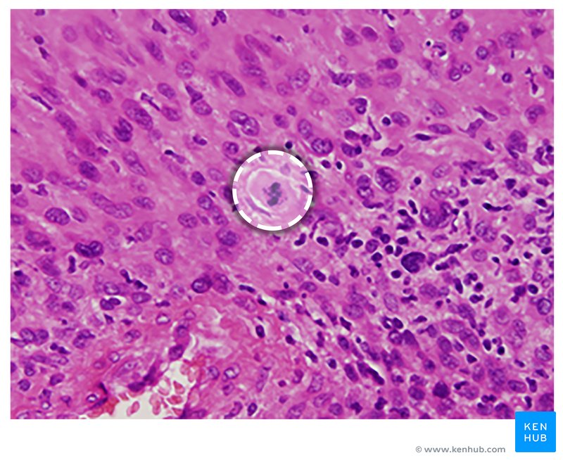 Malignant Peripheral Nerve Sheath Tumor - Histology
