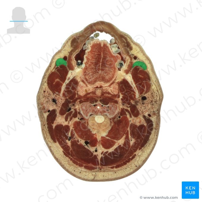 Coxim gorduroso bucal (Corpus adiposum buccae); Imagem: National Library of Medicine