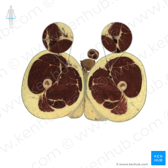 Femoral nerve (Nervus femoralis); Image: National Library of Medicine