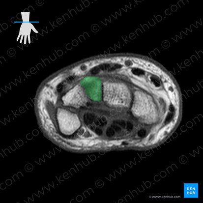 Osso hamato (Os hamatum); Imagem: 