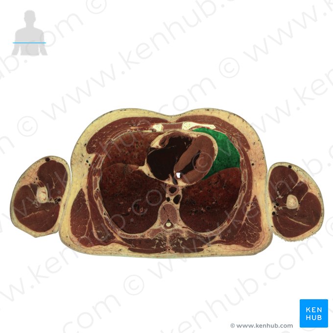 Lobo superior do pulmão esquerdo (Lobus superior pulmonis sinistri); Imagem: National Library of Medicine