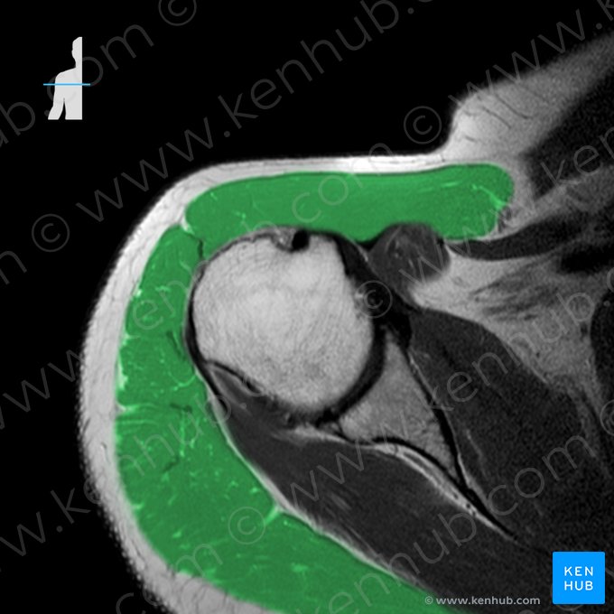 Deltoid muscle (Musculus deltoideus); Image: 