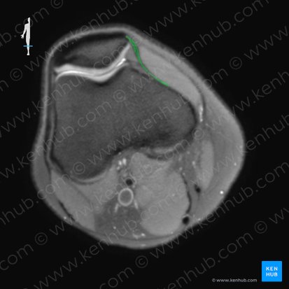 Retináculo patelar medial (Retinaculum patellae mediale); Imagen: 